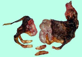 embryotomie arthrogrippose