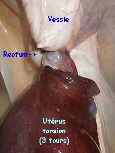 Torsion ut&eacute;rine